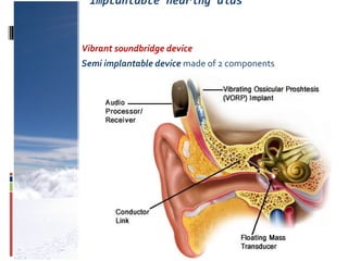 Implantable hearing aids
Vibrant soundbridge device
Semi implantable device made of 2 components
 