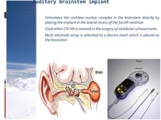 Auditory brainstem implant
 Stimulates the cochlear nuclear complex in the brainstem directly by
placing the implant in the lateral recess of the fourth ventricle.
 Used when CN VIII is severed in the surgery of vestibular schwannoma
 Multi electrode array is attached to a decron mesh which is placed on
the brainstem
 