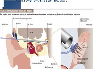 Auditory brainstem implant
 
