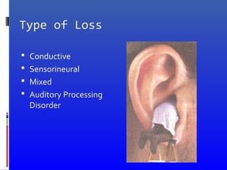 Type of Loss
 Conductive
 Sensorineural
 Mixed
 Auditory Processing
Disorder
 