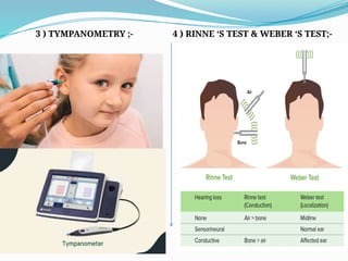 3 ) TYMPANOMETRY ;- 4 ) RINNE ‘S TEST & WEBER ‘S TEST;-
 