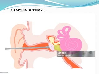 1 ) MYRINGOTOMY ;-
 