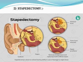 2) STAPEDECTOMY ;-
 