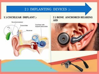2 ) IMPLANTING DEVICES ;-
1 ) COCHLEAR IMPLANT ;- 2 ) BONE ANCHORED HEARING
AID
 