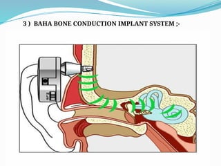3 ) BAHA BONE CONDUCTION IMPLANT SYSTEM ;-
 