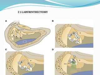 2 ) LABYRINTHECTOMY
 