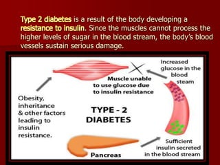 Type 2 diabetes is a result of the body developing a
resistance to insulin. Since the muscles cannot process the
higher le...