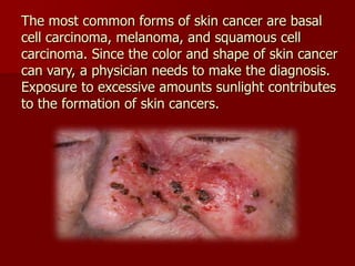 The most common forms of skin cancer are basal
cell carcinoma, melanoma, and squamous cell
carcinoma. Since the color and ...