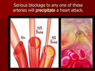 Serious blockage to any one of these
arteries will precipitate a heart attack.
 