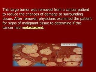 This large tumor was removed from a cancer patient
to reduce the chances of damage to surrounding
tissue. After removal, p...