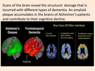 Scans of the brain reveal the structural damage that is
incurred with different types of dementia. An amyloid
plaque accumulates in the brains of Alzheimer’s patients
and contribute to their cognitive decline.
 
