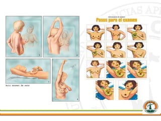 MAMA Y CÁNCER DE MAMA.