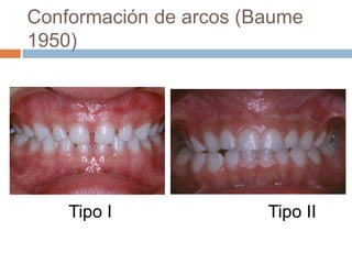 Conformación de arcos (Baume
1950)
Tipo I Tipo II
 