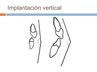 Implantación vertical
 