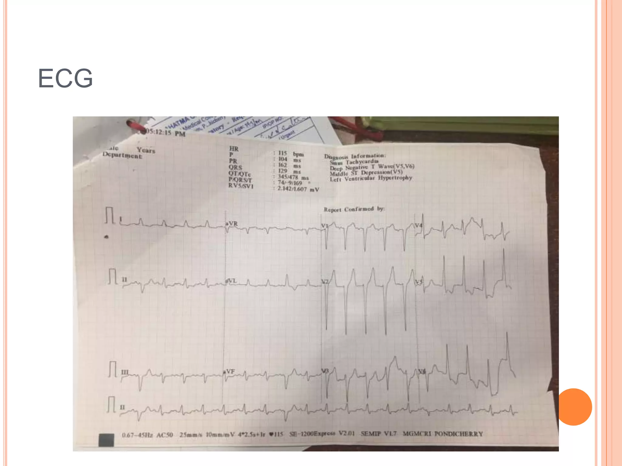 ECG
 