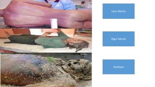 Autolysis
Rigor Mortis
Livor Mortis
 
