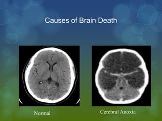 Causes of Brain Death




Normal             Cerebral Anoxia
 