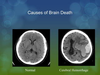 Causes of Brain Death




Normal         Cerebral Hemorrhage
 