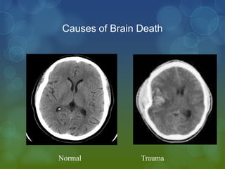 Causes of Brain Death




Normal          Trauma
 