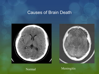 Causes of Brain Death




Normal          Meningitis
 
