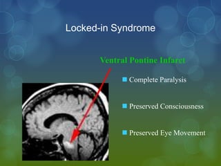 Locked-in Syndrome


      Ventral Pontine Infarct

            Complete Paralysis


            Preserved Consciousness


            Preserved Eye Movement
 