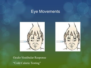 Eye Movements




Oculo-Vestibular Response
“Cold Caloric Testing”
 