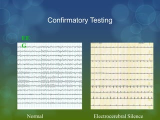 Confirmatory Testing

EE
G




 Normal                 Electrocerebral Silence
 