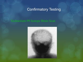 Confirmatory Testing


Technetium-99 Isotope Brain Scan
 