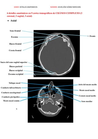 DEBER: DETALLES ANATOMICOS NOMBRE: KEVIN JÓSE GÓMEZ MERCHÁN
6 detalles anatómicos en 9 cortes tomográficos de CRÁNEO COMPLETO (3
coronal, 3 sagital, 3 axial)
 Axial
 