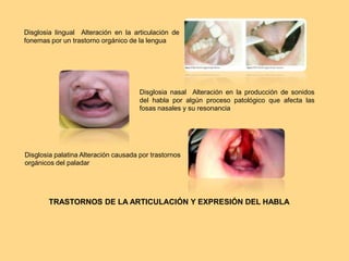 Disglosia lingual Alteración en la articulación de
fonemas por un trastorno orgánico de la lengua
Disglosia palatina Alteración causada por trastornos
orgánicos del paladar
Disglosia nasal Alteración en la producción de sonidos
del habla por algún proceso patológico que afecta las
fosas nasales y su resonancia
TRASTORNOS DE LA ARTICULACIÓN Y EXPRESIÓN DEL HABLA
 