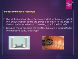 The recommended technique
 Use of Debonding pliers: Recommended technique in which
the chisel shaped beaks are placed as close to the base of
the bracket as possible and a peeling type force is applied.
 Because metal brackets are ductile, this force is transmitted to
the adhesive bond, breaking it
 