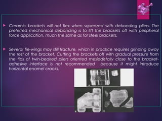  Ceramic brackets will not flex when squeezed with debonding pliers. The
preferred mechanical debonding is to lift the brackets off with peripheral
force application, much the same as for steel brackets.
 Several tie-wings may still fracture, which in practice requires grinding away
the rest of the bracket. Cutting the brackets off with gradual pressure from
the tips of twin-beaked pliers oriented mesiodistally close to the bracket-
adhesive interface is not recommended because it might introduce
horizontal enamel cracks.
 