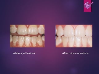 White spot lesions After micro- abrations
 