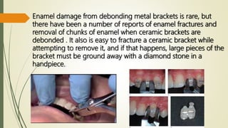 Debonding and composite remanants removal | PPTX