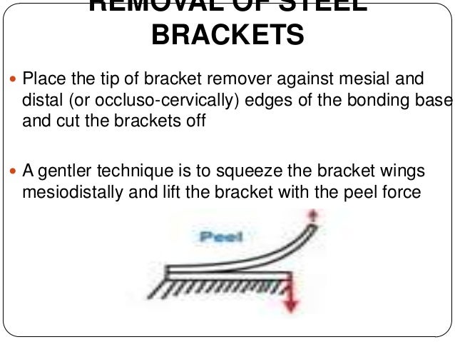 Debonding Procedures In Orthodontics
