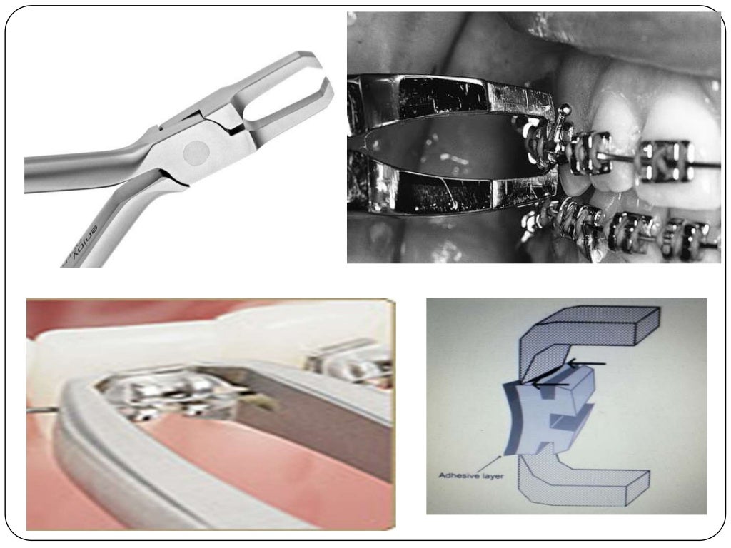 Debonding procedures in orthodontics