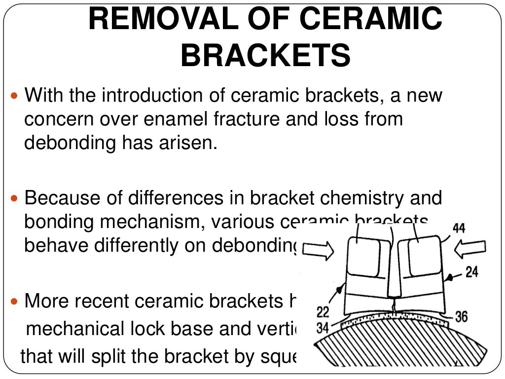 Debonding procedures in orthodontics