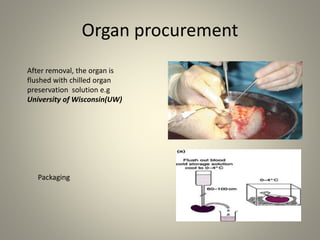 Organ procurement
After removal, the organ is
flushed with chilled organ
preservation solution e.g
University of Wisconsin(UW)
Packaging
 