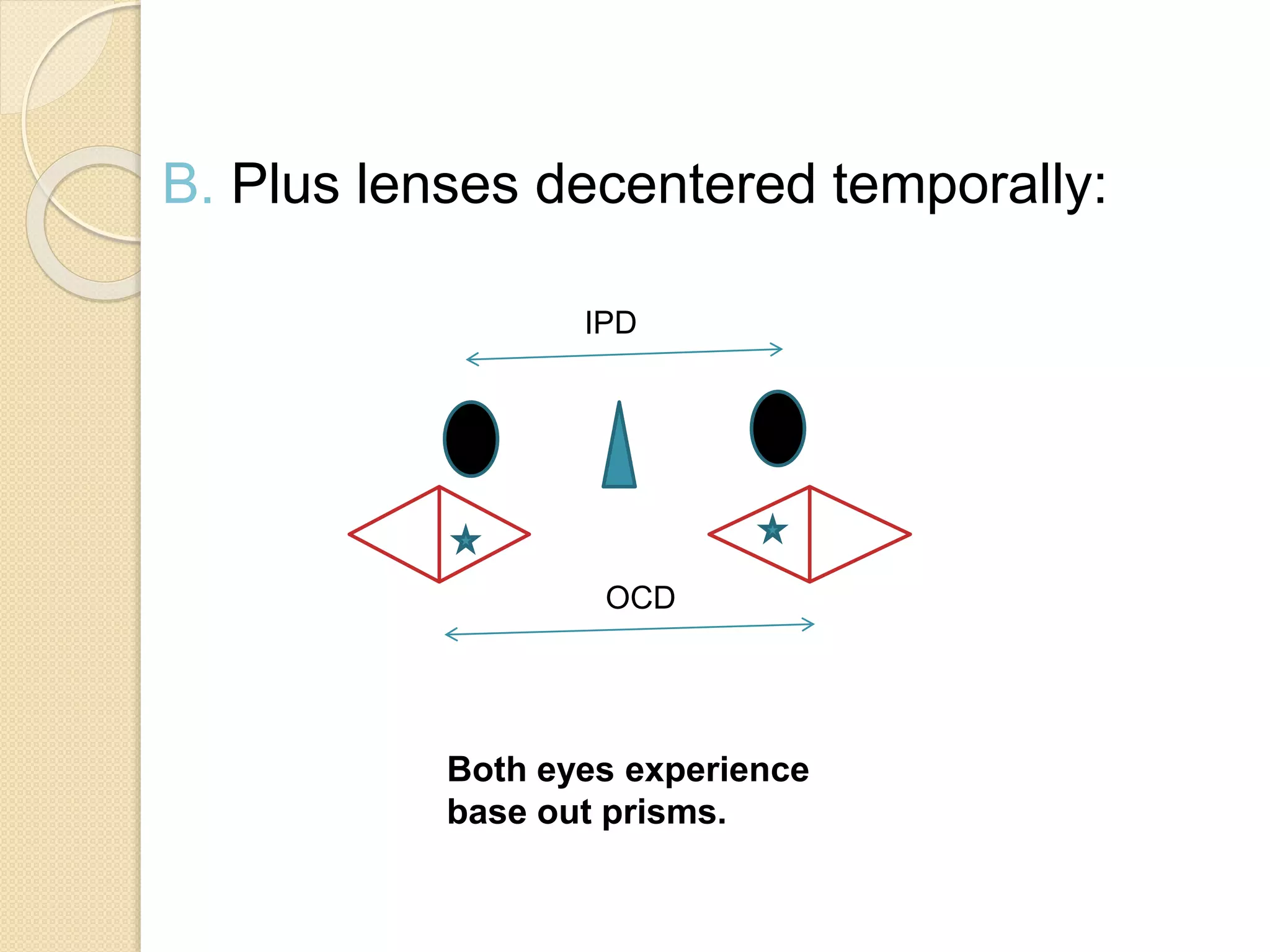 B. Plus lenses decentered temporally:
Both eyes experience
base out prisms.
IPD
OCD
 