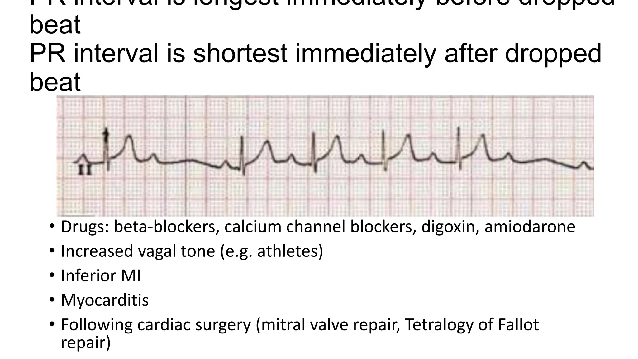 DECIPHERING COMMON ECG FINDINGS IN ED.pptx