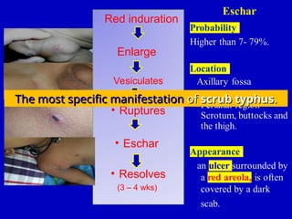 Decoding -Rickettesial Fever in Children.ppt