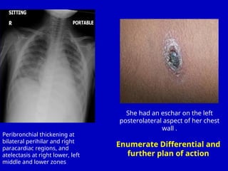 Decoding -Rickettesial Fever in Children.ppt