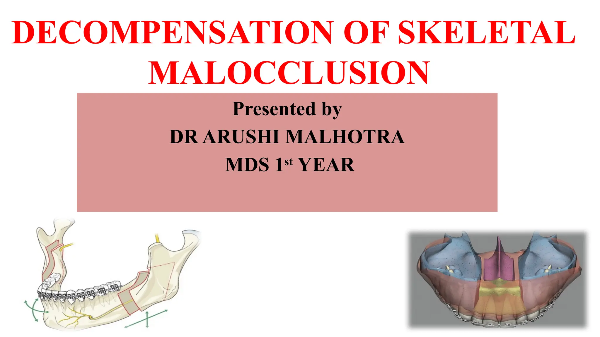 decompensation of skeletal malocclusion.pptx