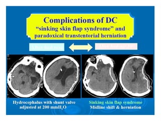 DECRA trail
(Decompressive Craniectomy in Diffuse Traumatic Brain Injury . N Engl J Med. 2011 Apr 21;364(16):1493-502)
• M...