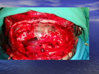 decompressive_craniectomy and it's managemnet | PDF