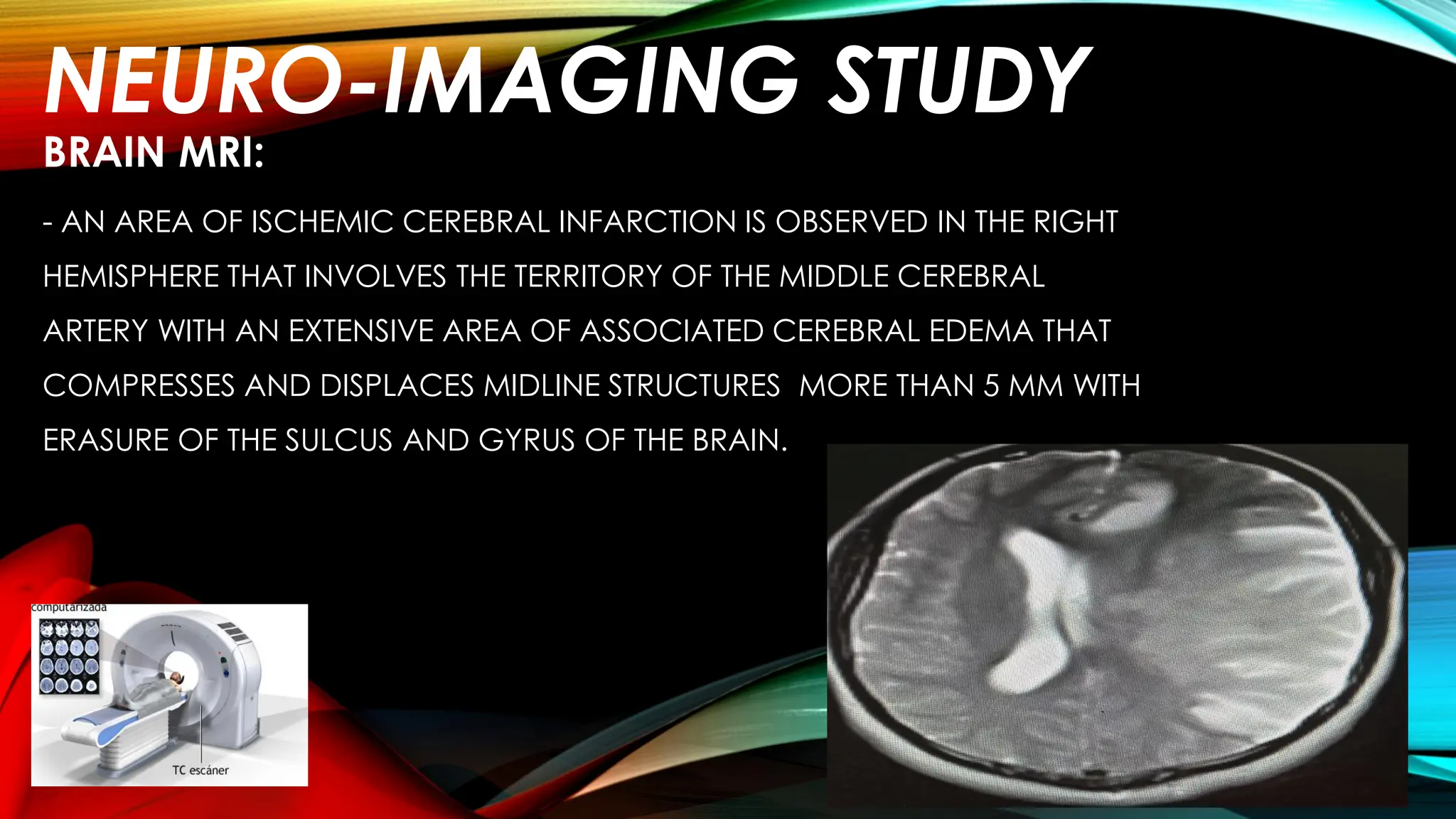 DECOMPRESSIVE CRANIECTOMY IN MALIGNANT ISCHEMIC INFARCTION OF THE ...