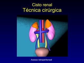 Cisto renal Técnica cirúrgica Acesso retroperitoneal 