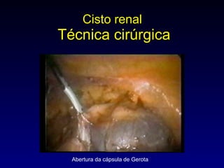 Cisto renal   Técnica cirúrgica Abertura da cápsula de Gerota 