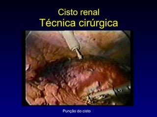 Cisto renal Técnica cirúrgica Punção do cisto 