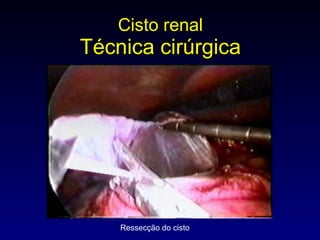 Cisto renal Técnica cirúrgica Ressecção do cisto 